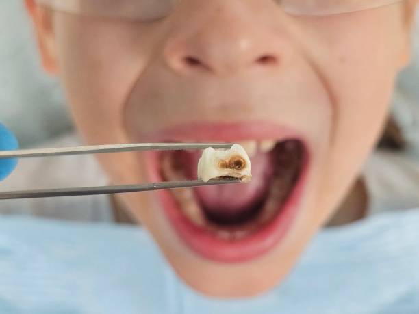Best Emergency Tooth Extraction in Elwood, UT